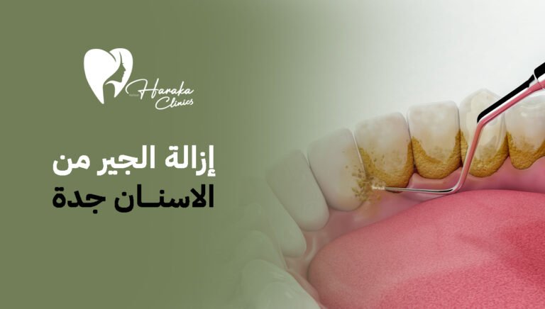إزالة الجير من الأسنان جدة