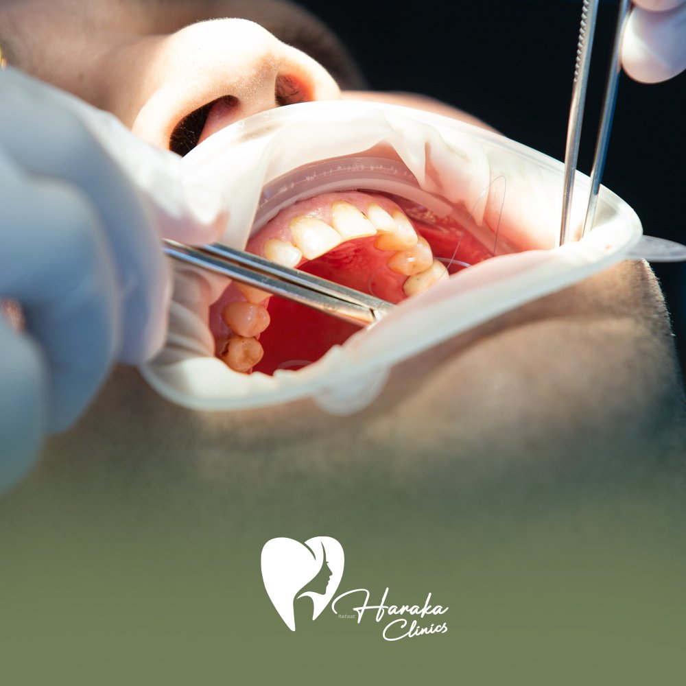 افضل حشوات الاسنان جدة محتوى