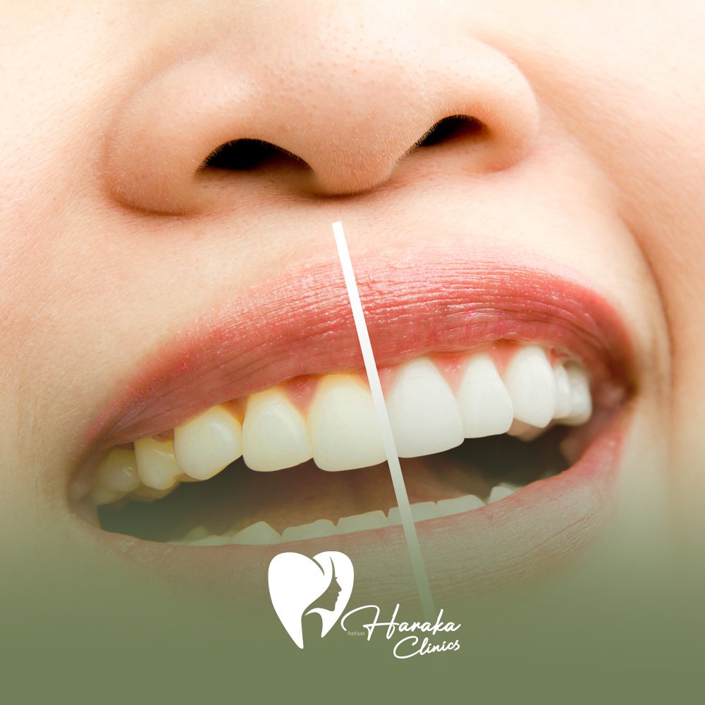 تبييض الأسنان