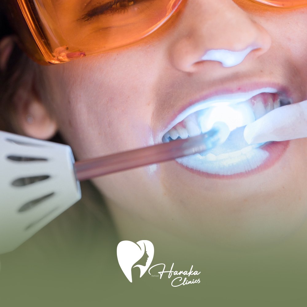 تبييض الاسنان بالليزر جدة محتوى (1)