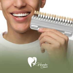 تجميل الأسنان بالفينير