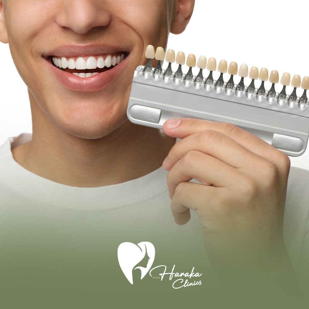 تجميل الأسنان بالفينير