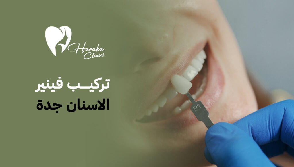 كل ما تحتاج معرفته عن تركيب فينير الاسنان جدة خطوة بخطوة