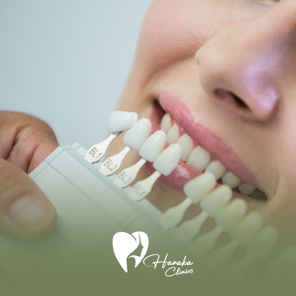 تركيب فينير الاسنان جدة