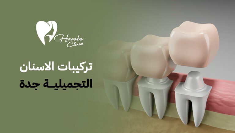 تركيبات الأسنان التجميلية جدة