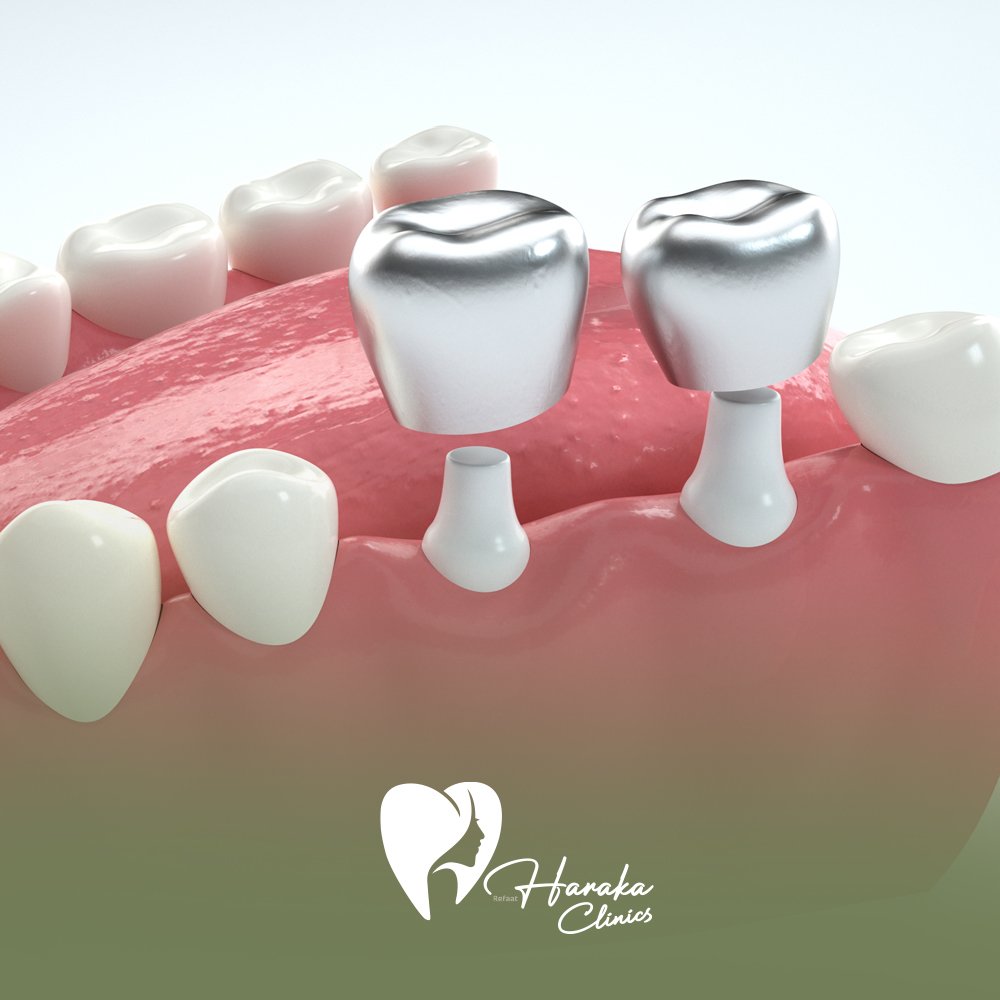 تركيبات الأسنان التجميلية جدة