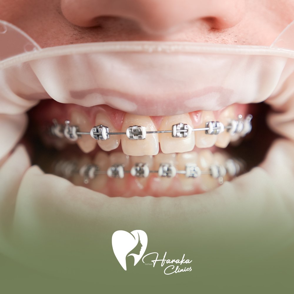 تقويم معدني