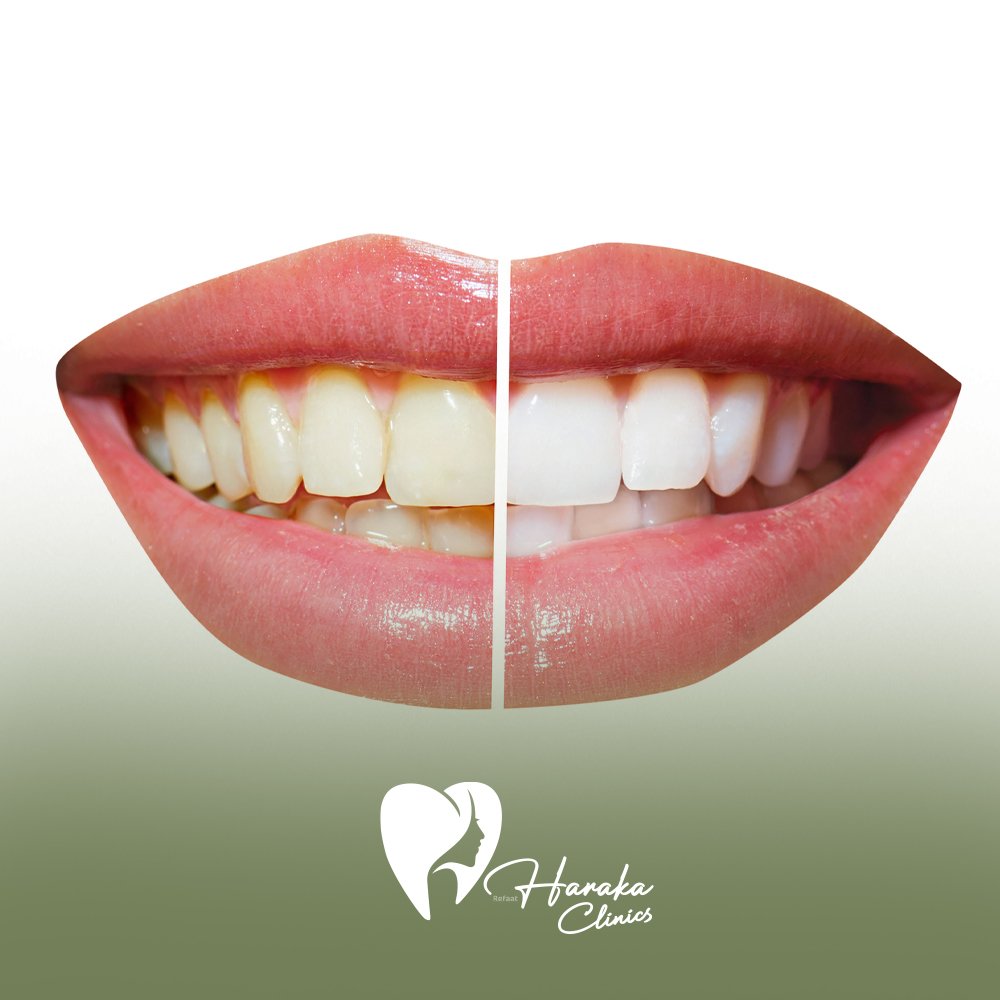 تنظيف وتبييض الاسنان جدة