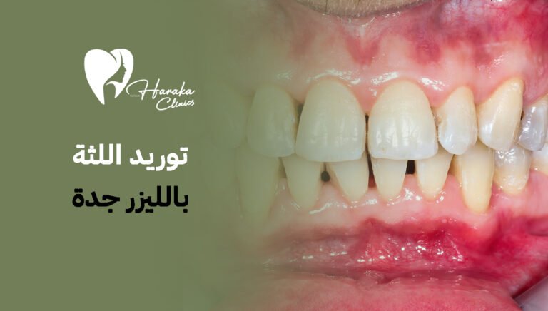 توريد اللثة بالليزر جدة