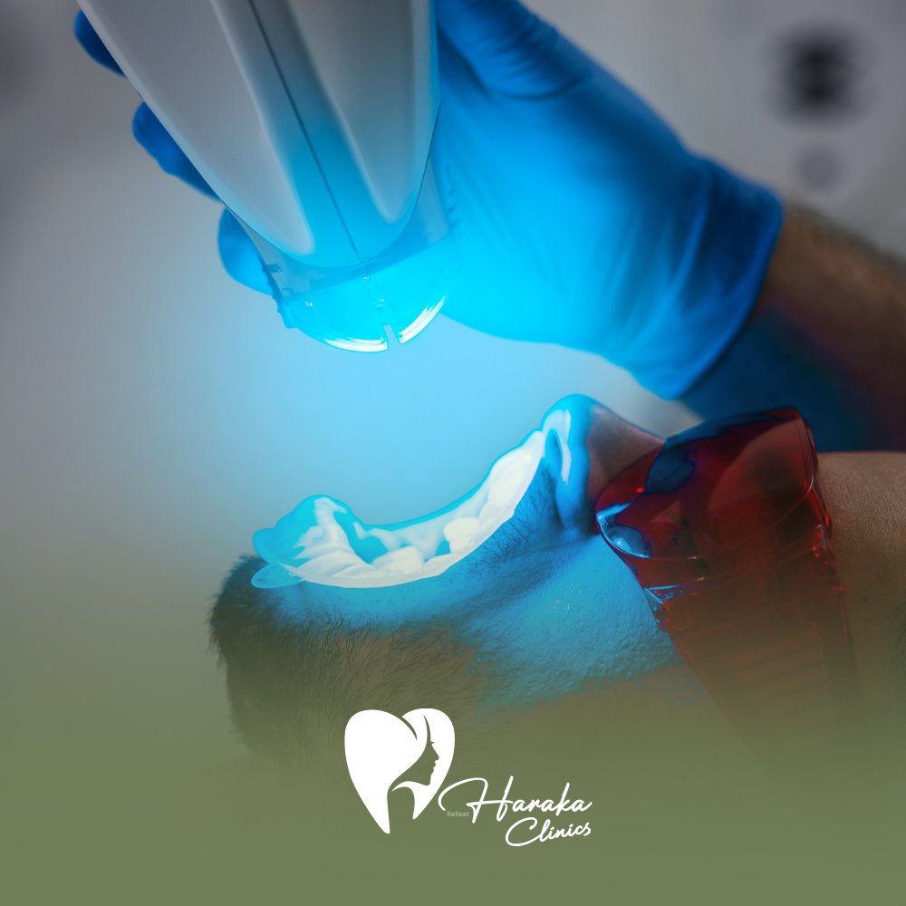 توريد اللثة بالليزر جدة محتوى