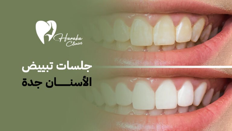 جلسات تبييض الأسنان جدة