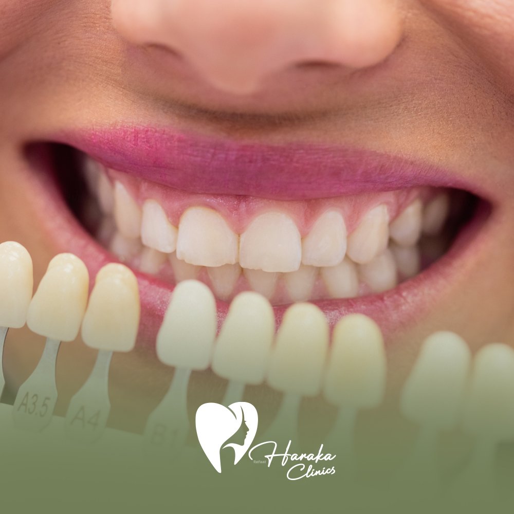 جلسات تبييض الأسنان جدة