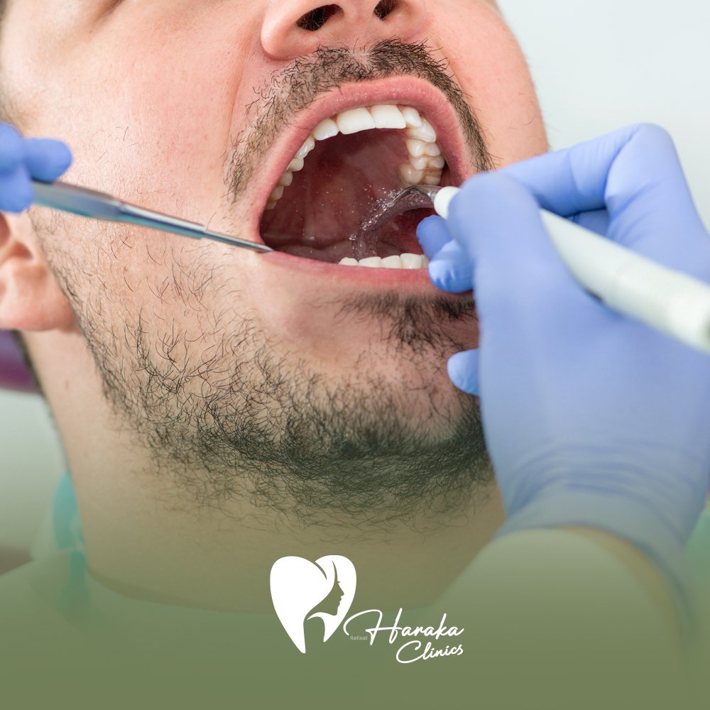 خلع الاسنان