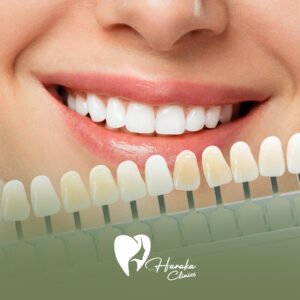 دايركت ڤينير