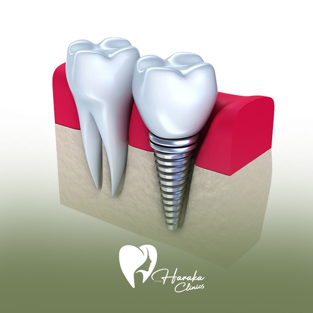 زراعه اسنان