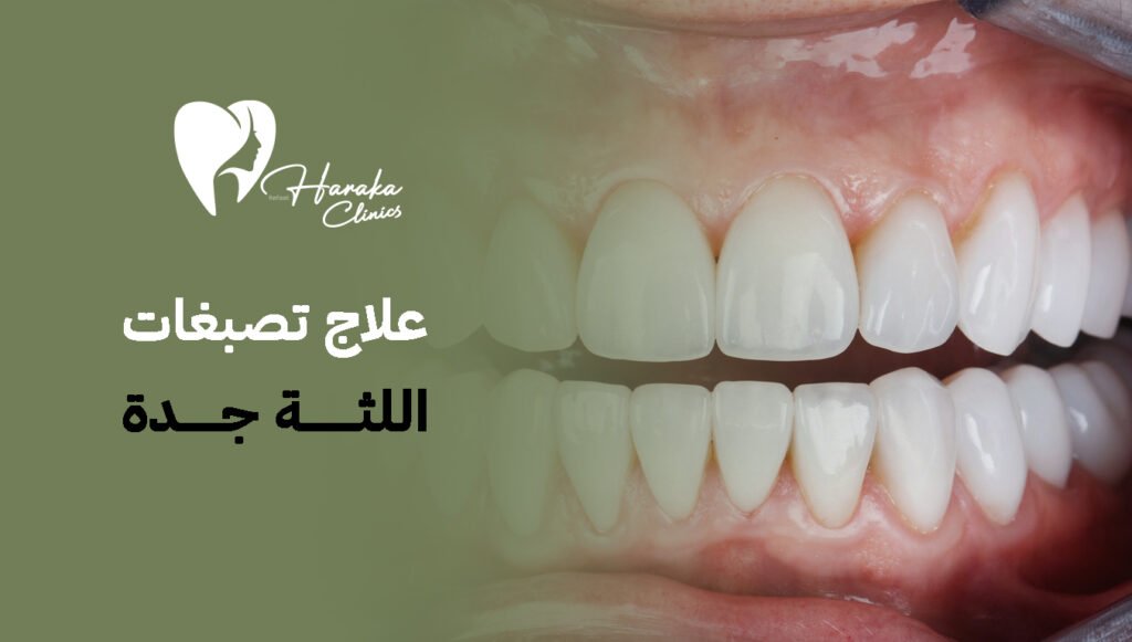 كل ما تحتاج معرفته عن علاج تصبغات اللثة جدة 2026