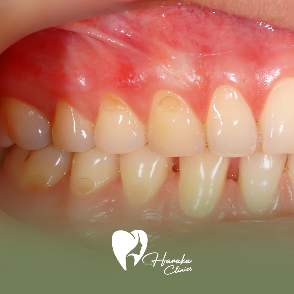 علاج تصبغات اللثة جدة