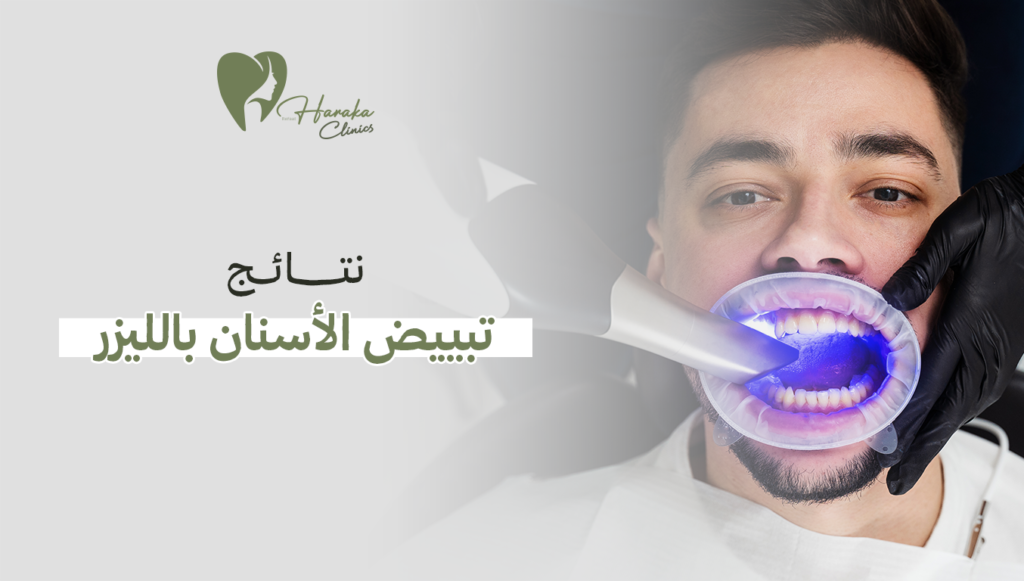 نتائج تبييض الأسنان بالليزر | ابتسامة مشرقة بأقل وقت