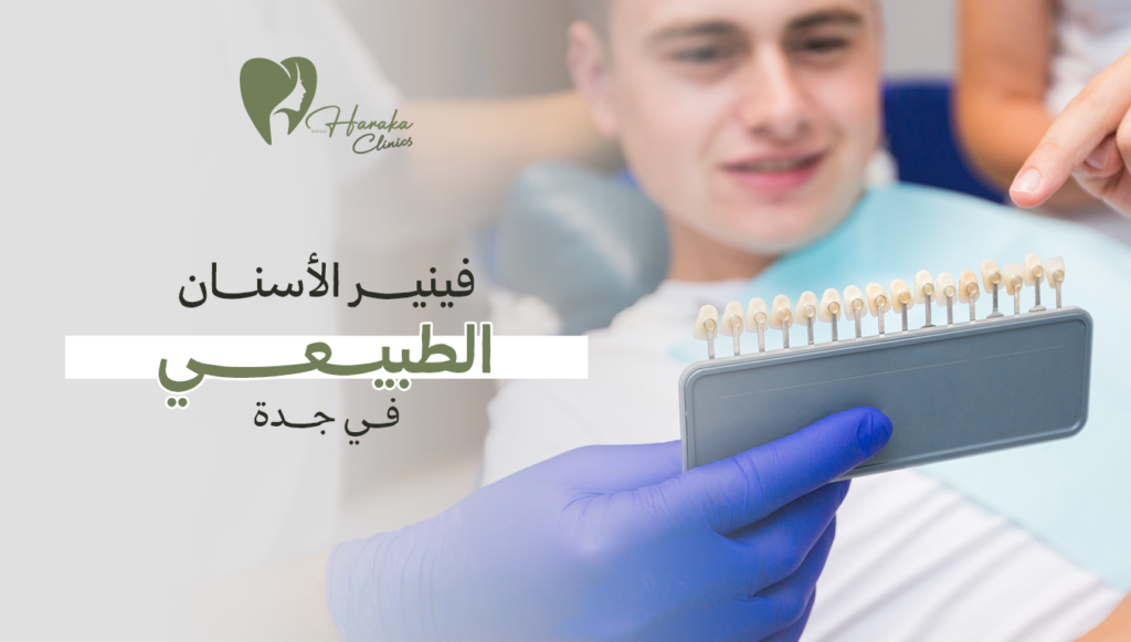 فينير الأسنان الطبيعي في جدة | ابتسامة فاخرة بمظهر طبيعي