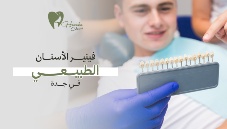 فينير الأسنان الطبيعي في جدة