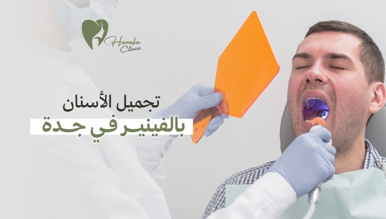 تجميل الأسنان بالفينير في جدة
