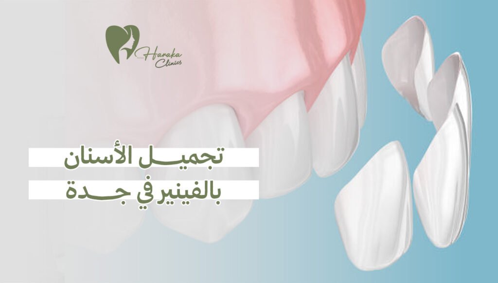 تجميل الأسنان بالفينير في جدة