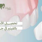 تجميل الأسنان بالفينير في جدة