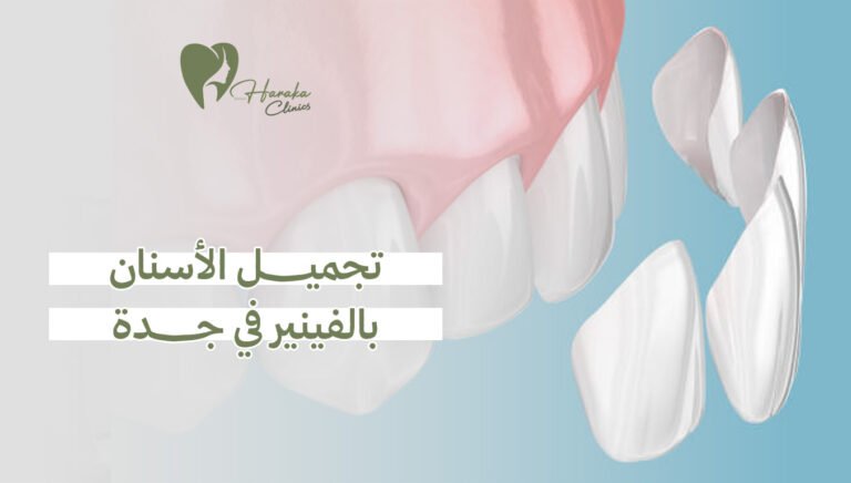 تجميل الأسنان بالفينير في جدة