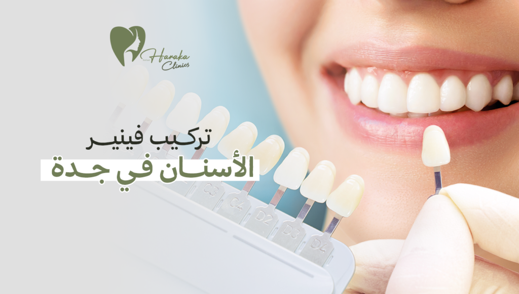 تركيب فينير الأسنان في جدة – ابتسامة جميلة تدوم