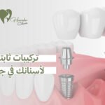 تركيبات ثابتة لأسنانك في جدة