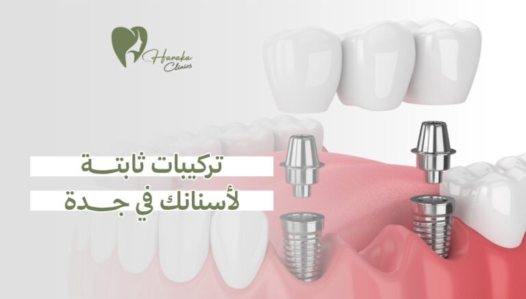 تركيبات ثابتة لأسنانك في جدة