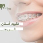تقويم أسنان معدني في جدة