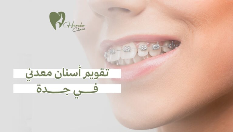 تقويم أسنان معدني في جدة