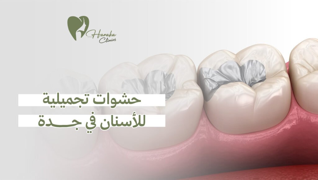 حشوات تجميلية للأسنان في جدة