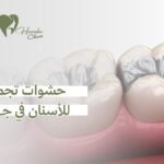 حشوات تجميلية للأسنان في جدة