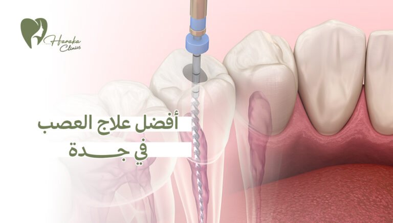 أفضل علاج العصب في جدة