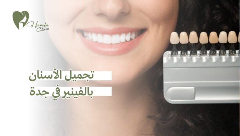 تجميل الأسنان بالفينير في جدة