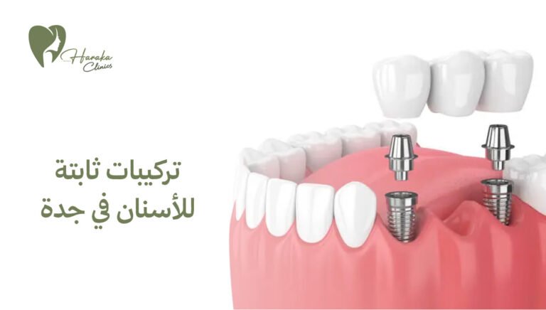 تركيبات ثابتة للأسنان في جدة