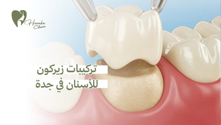 تركيبات زيركون للأسنان في جدة