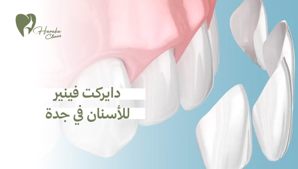 دايركت فينير للأسنان في جدة – ابتسامة مشرقة ونتائج فورية