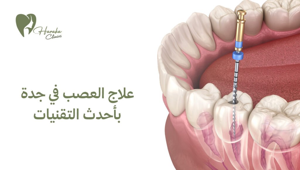 علاج العصب في جدة بأحدث التقنيات | لعلاج الأسنان بشكل فعال وآمن
