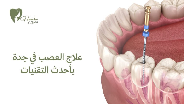 علاج العصب في جدة بأحدث التقنيات