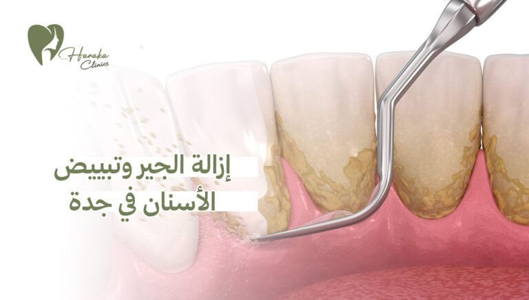 إزالة الجير وتبييض الأسنان في جدة