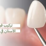 تركيب فينير الأسنان في جدة