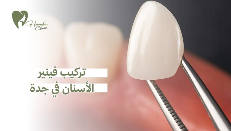 تركيب فينير الأسنان في جدة