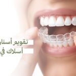 تقويم أسنان بدون أسلاك في جدة