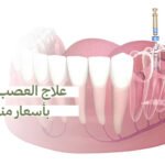 علاج العصب في جدة بأسعار مناسبة