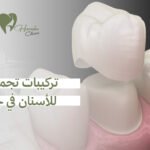 تركيبات تجميلية للأسنان في جدة